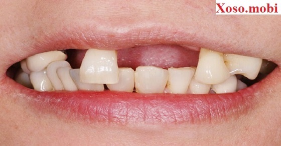 Mơ thấy rụng răng